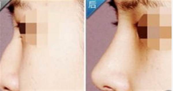 硅膠<a href=http://m.f3bb6.cn/listinfo-737-0.html target=_blank class=infotextkey>隆鼻</a>排異哪些特點