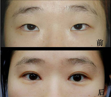 韓式切開法就是全切嗎