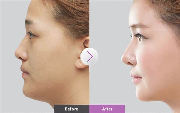 耳軟骨墊<a href=http://m.f3bb6.cn/listinfo-757-0.html target=_blank class=infotextkey>鼻尖</a>發(fā)白怎么辦