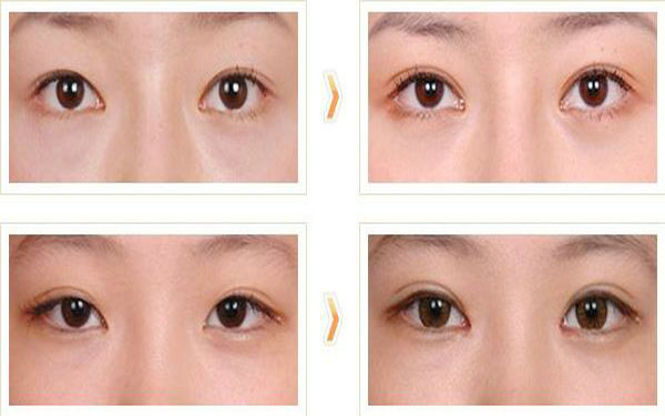 哪些人不適合做<a href=http://m.f3bb6.cn/listinfo-724-0.html target=_blank class=infotextkey>雙眼皮</a>?