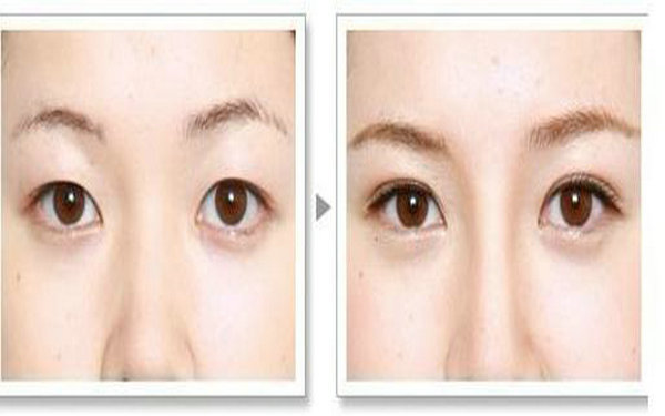 哪種<a href=http://m.f3bb6.cn/listinfo-724-0.html target=_blank class=infotextkey>雙眼皮</a>手術較好?