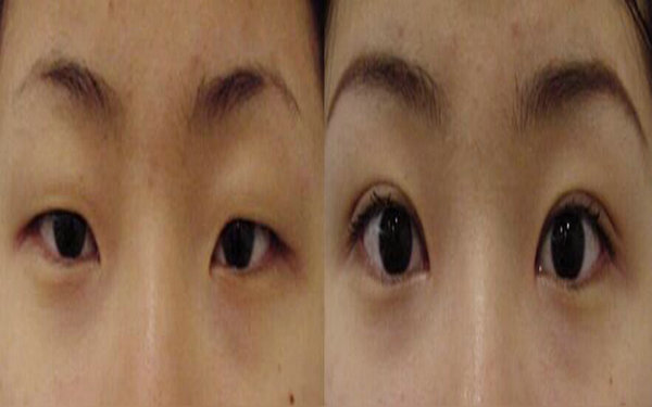 納米<a href=http://m.f3bb6.cn/listinfo-724-0.html target=_blank class=infotextkey>雙眼皮</a>保持幾年?