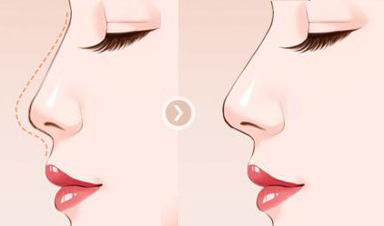 南京假體<a href=http://m.f3bb6.cn/listinfo-737-0.html target=_blank class=infotextkey>隆鼻</a>手術(shù)價(jià)格