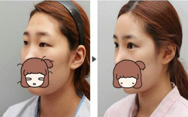 納米無痕可以維持幾年?