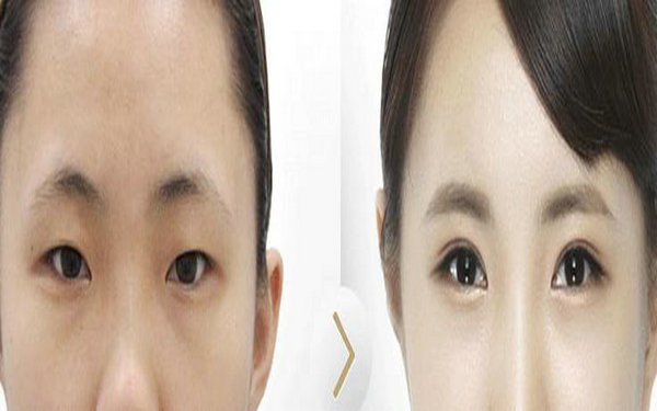 納米無(wú)痕是長(zhǎng)期的嗎?