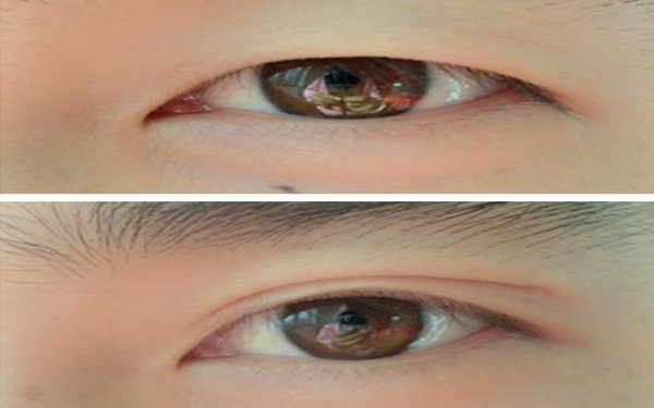 納米無痕<a href=http://m.f3bb6.cn/listinfo-724-0.html target=_blank class=infotextkey>雙眼皮</a>的缺點?