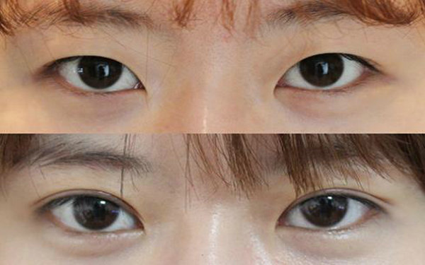 納米無痕<a href=http://m.f3bb6.cn/listinfo-724-0.html target=_blank class=infotextkey>雙眼皮</a>的原理?