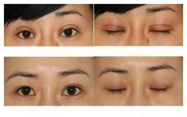 南寧割<a href=http://m.f3bb6.cn/listinfo-724-0.html target=_blank class=infotextkey>雙眼皮</a>多少錢?