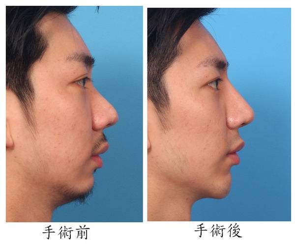 墊下巴和<a href=http://m.f3bb6.cn/listinfo-737-0.html target=_blank class=infotextkey>隆鼻</a>哪個痛苦