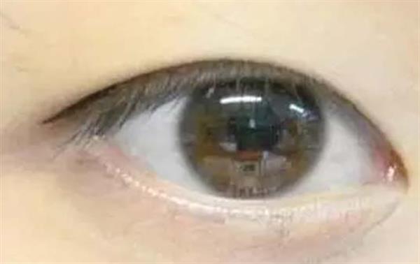 內切眼袋手術后的恢復期