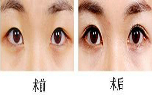 內雙割什么<a href=http://m.f3bb6.cn/listinfo-724-0.html target=_blank class=infotextkey>雙眼皮</a>好看?