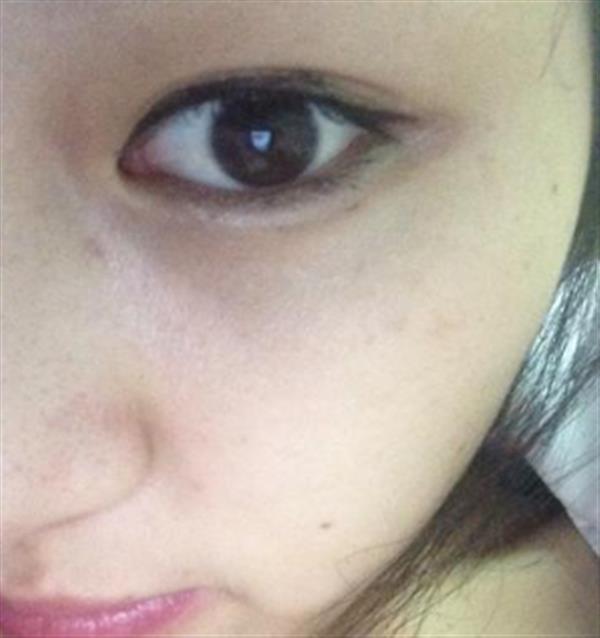 眼皮抽脂反彈的概率高不高