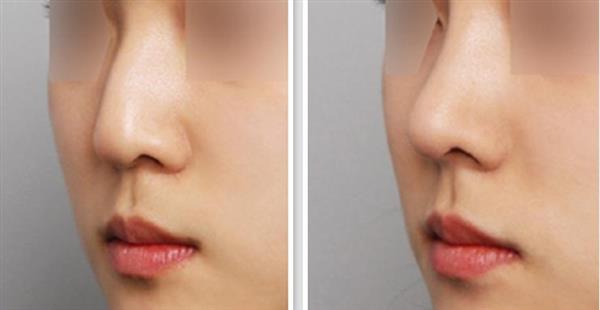 駝峰鼻治療的費(fèi)用是多少