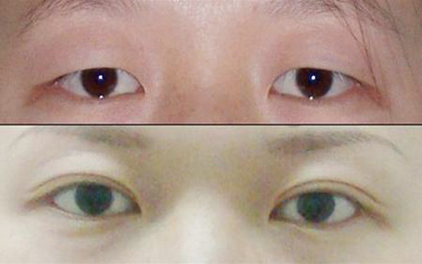 切開<a href=http://m.f3bb6.cn/listinfo-724-0.html target=_blank class=infotextkey>雙眼皮</a>會留疤嗎?