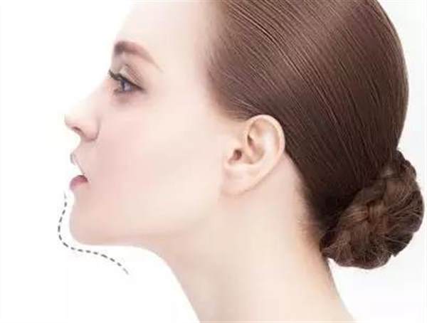 做墊下巴多少錢