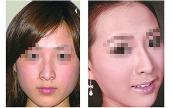 哪些人不適合硅膠<a href=http://m.f3bb6.cn/listinfo-737-0.html target=_blank class=infotextkey>隆鼻</a>?