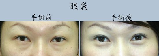 割眼袋還會復發嗎