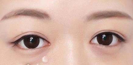 黑眼袋怎樣去除