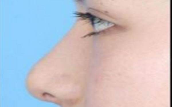 膨體<a href=http://m.f3bb6.cn/listinfo-737-0.html target=_blank class=infotextkey>隆鼻</a>的缺點是什么?