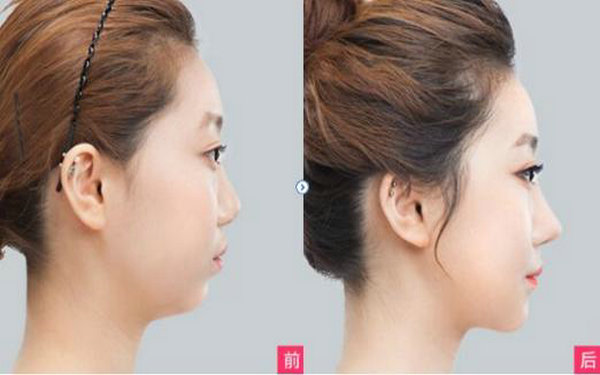 膨體<a href=http://m.f3bb6.cn/listinfo-737-0.html target=_blank class=infotextkey>隆鼻</a>后多久能變軟?