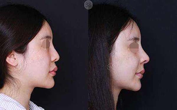 異體肋骨<a href=http://m.f3bb6.cn/listinfo-737-0.html target=_blank class=infotextkey>隆鼻</a>