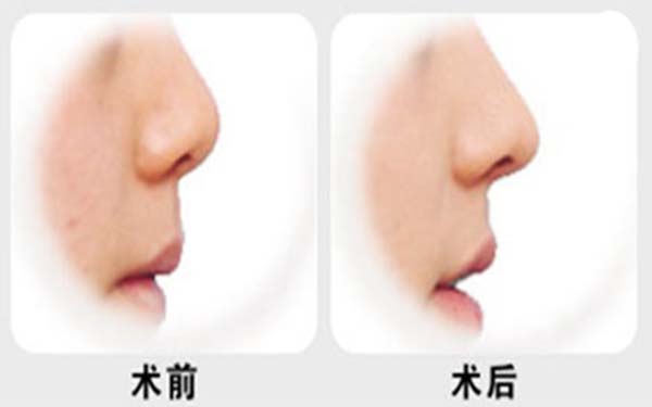 自體肋骨<a href=http://m.f3bb6.cn/listinfo-737-0.html target=_blank class=infotextkey>隆鼻</a>