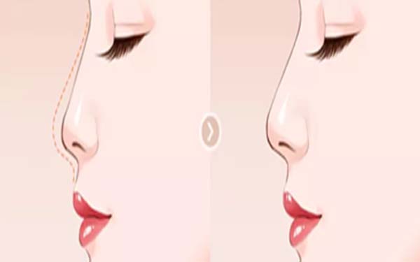 軟肋骨<a href=http://m.f3bb6.cn/listinfo-737-0.html target=_blank class=infotextkey>隆鼻</a>