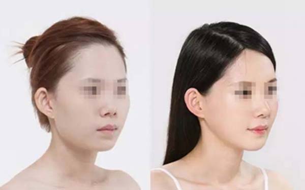 肋骨<a href=http://m.f3bb6.cn/listinfo-737-0.html target=_blank class=infotextkey>隆鼻</a>術