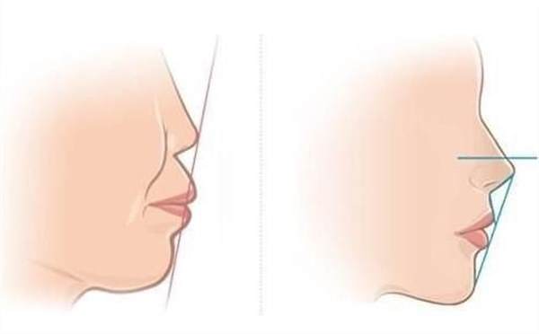 14歲齙牙矯正要多少錢