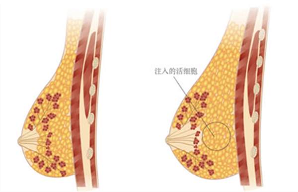復合<a href=http://m.f3bb6.cn/listinfo-618-0.html target=_blank class=infotextkey>隆胸</a>的好處
