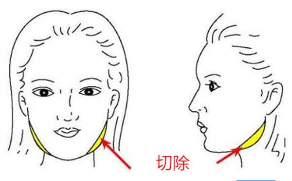 切除咬肌多少錢