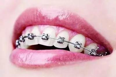 寒假迎矯牙高峰 4個誤區要避開