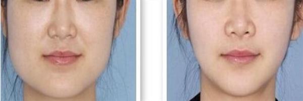 打<a href=http://m.f3bb6.cn/listinfo-631-0.html target=_blank class=infotextkey>瘦臉</a><a href=http://m.f3bb6.cn/listinfo-614-0.html target=_blank class=infotextkey>除皺</a>到底好不好