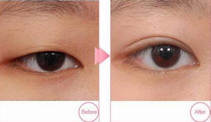 全切<a href=http://m.f3bb6.cn/listinfo-724-0.html target=_blank class=infotextkey>雙眼皮</a>整形多久能完全恢復(fù)