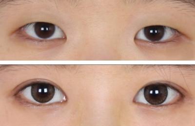 全切<a href=http://m.f3bb6.cn/listinfo-724-0.html target=_blank class=infotextkey>雙眼皮</a>術(shù)中過程如何？