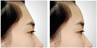 自由脂肪<a href=http://m.f3bb6.cn/listinfo-643-0.html target=_blank class=infotextkey>豐額頭</a>多少錢