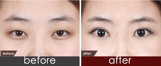 全切<a href=http://m.f3bb6.cn/listinfo-724-0.html target=_blank class=infotextkey>雙眼皮</a>多久能化妝