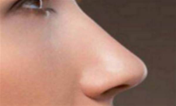 透明質酸<a href=http://m.f3bb6.cn/listinfo-737-0.html target=_blank class=infotextkey>隆鼻</a>持續時間多長