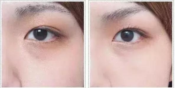 超聲波<a href=http://m.f3bb6.cn/listinfo-708-0.html target=_blank class=infotextkey>去眼袋</a>安全嗎