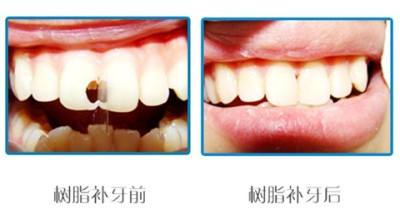 牙齒斷了一半怎么修復