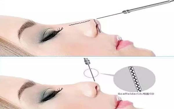 假體<a href=http://m.f3bb6.cn/listinfo-737-0.html target=_blank class=infotextkey>隆鼻</a>如何選材料