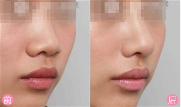 做<a href=http://m.f3bb6.cn/listinfo-737-0.html target=_blank class=infotextkey>隆鼻</a>手術前注意