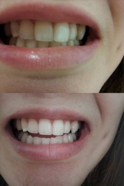 牙齒發黃怎么辦呢