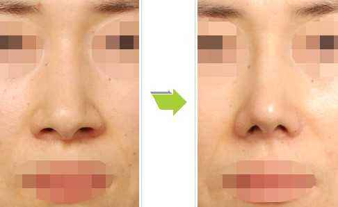 鼻頭鼻子縮小多少錢