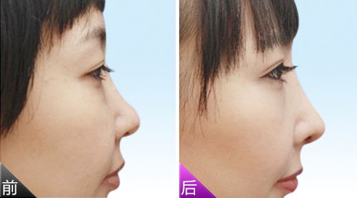 注射<a href=http://m.f3bb6.cn/listinfo-737-0.html target=_blank class=infotextkey>隆鼻</a>價格貴嗎