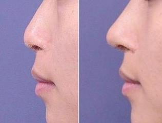 假體<a href=http://m.f3bb6.cn/listinfo-737-0.html target=_blank class=infotextkey>隆鼻</a>歪了如何補救