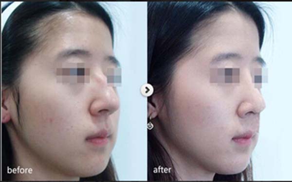 <a href=http://m.f3bb6.cn/listinfo-737-0.html target=_blank class=infotextkey>隆鼻</a>幾天可以拆線