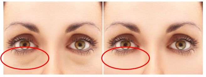 眼袋手術(shù)幾天能恢復(fù)