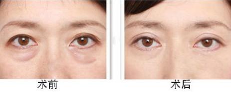 超聲波<a href=http://m.f3bb6.cn/listinfo-708-0.html target=_blank class=infotextkey>去眼袋</a>手術(shù)好不好 大概需要多少錢(qián)