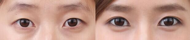 超聲波<a href=http://m.f3bb6.cn/listinfo-708-0.html target=_blank class=infotextkey>去眼袋</a>后眼眶塌陷有什么辦法恢復